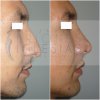 RINOPLASTIA 1